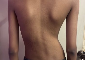 Mohamad Andy 2_before surgery